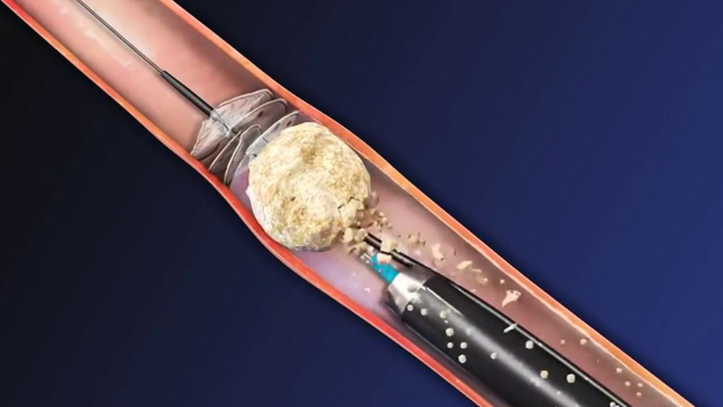 Mức độ nguy hiểm của sỏi niệu quản 1/3 giữa và cách điều trị 1