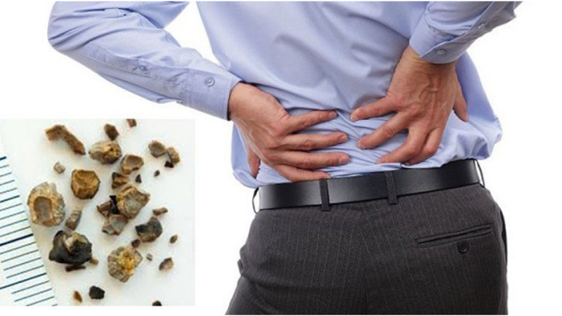 Mức độ nguy hiểm của sỏi niệu quản 1/3 giữa và cách điều trị 4