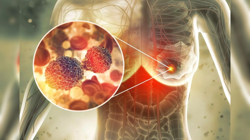 Liệu pháp nội tiết trong điều trị ung thư vú là gì? Mục tiêu sử dụng trong điều trị 2