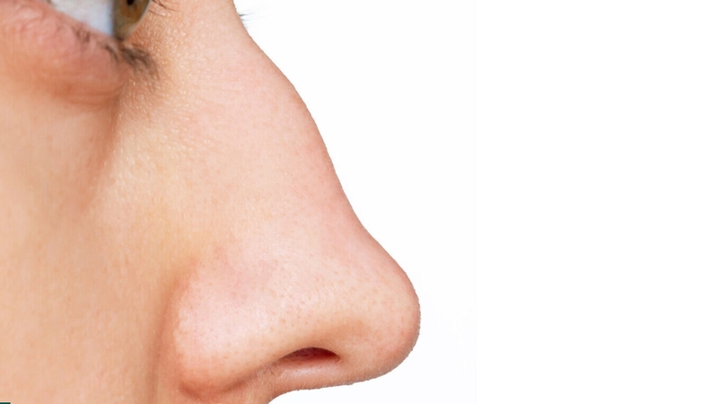 Mũi gồ là gì? Nguyên nhân và cách khắc phục mũi gồ hiệu quả 1