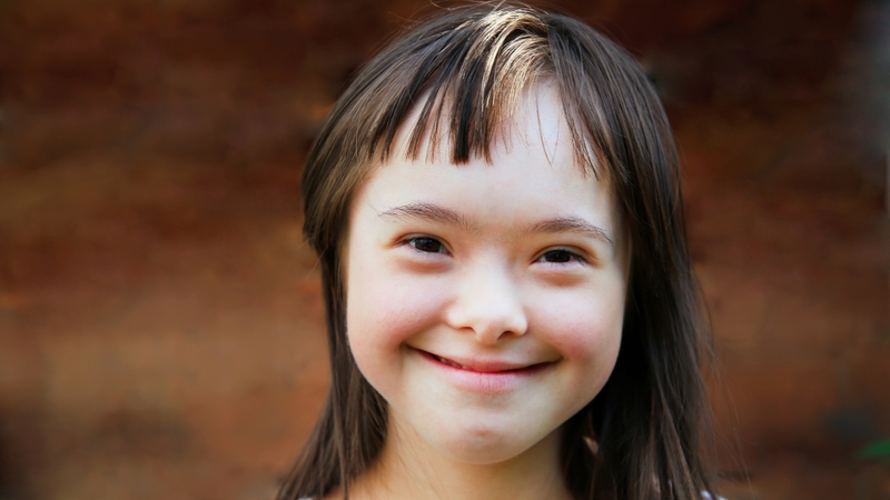 Hội chứng Down có thể đi kèm với đặc điểm mũi tẹt do bất thường cấu trúc xương mặt và mũi