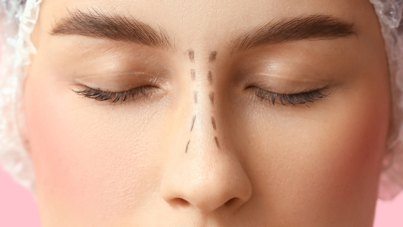 Nâng mũi phẫu thuật cần thực hiện bởi bác sĩ chuyên khoa có kinh nghiệm để đảm bảo an toàn và thẩm mỹ