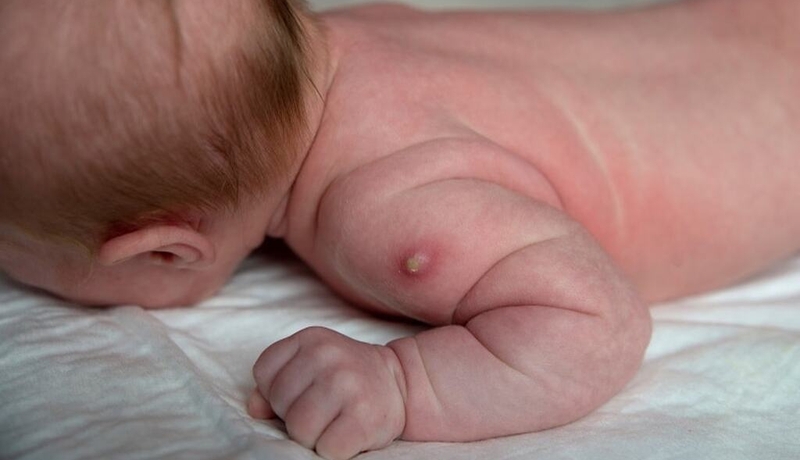 Mũi tiêm để lại sẹo là mũi gì? Những thông tin liên quan đến sự hình thành sẹo sau tiêm 3