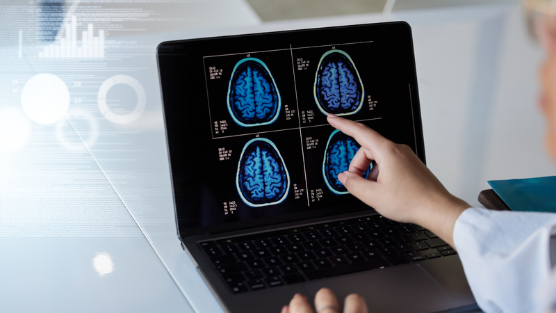 Multiple Sclerosis là gì? Triệu chứng, chẩn đoán và điều trị bệnh 3