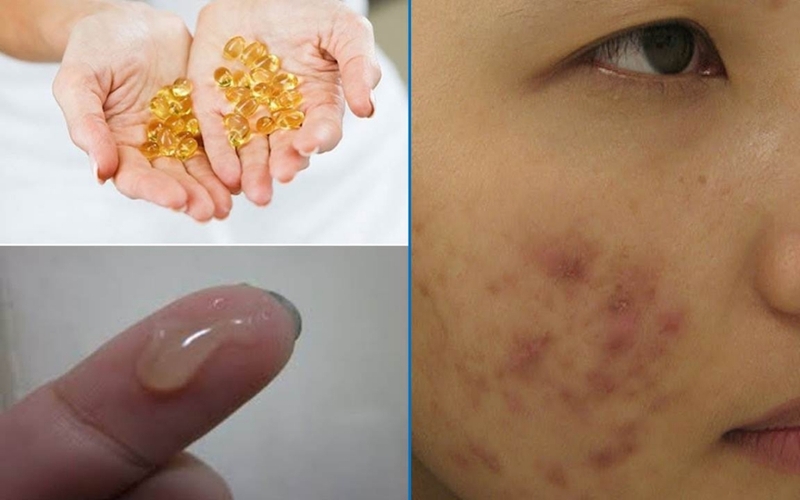 tai-sao-uong-vitamin-e-bi-noi-mun-1