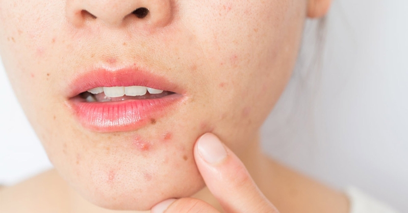 da-bi-mun-do-thieu-chat-gi-nhung-luu-y-khi-dieu-tri-da-mun-2