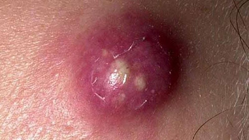 Mụn áp xe là gì? Nguyên nhân và cách điều trị hiệu quả 1