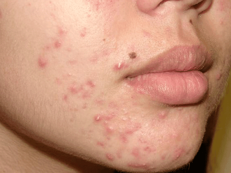 Bật mí các cách trị mụn bọc sưng đỏ cực đơn giản 1