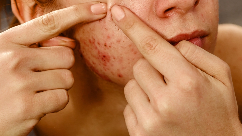 Mụn bọc bao lâu thì chín? Cách nhận biết và xử lý đúng thời điểm để tránh để lại sẹo 4