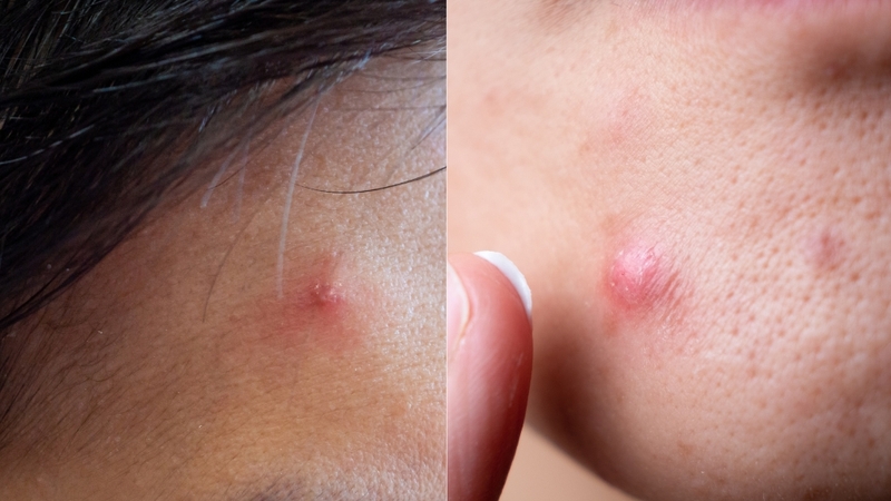 Mụn bọc không đầu thường do lỗ chân lông bị bít tắc hoặc thay đổi nội tiết gây viêm sâu dưới da