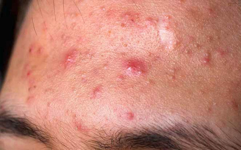 Bật mí các cách trị mụn bọc cực đơn giản và hiệu quả 2
