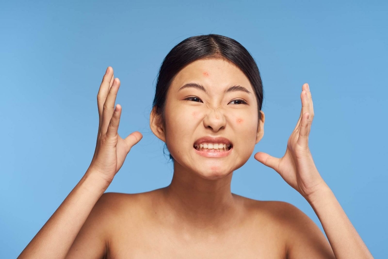 Mụn bọc ở cằm là gì? Có nguy hiểm không? Có nên tự nặn không?3