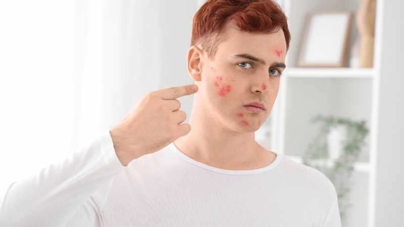 Mụn bọc ở má được xếp vào nhóm mụn trứng cá viêm nặng