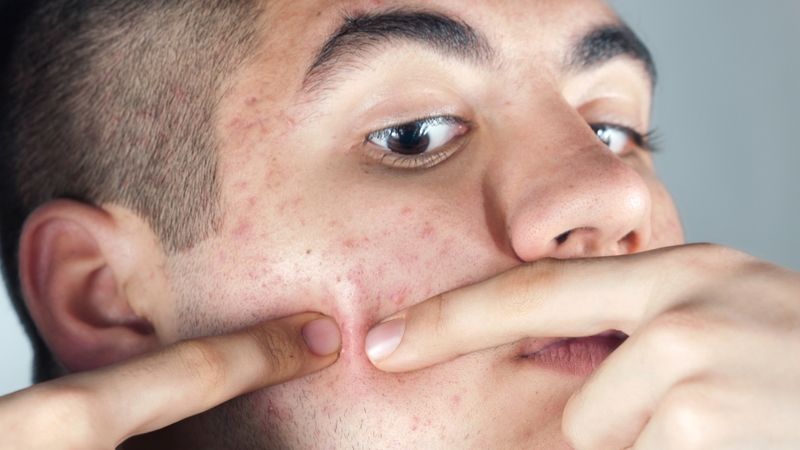 Việc tự ý nặn mụn tại nhà không được khuyến khích vì có thể gây ra nhiều rủi ro