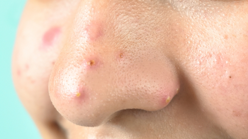 Mụn bọc ở mũi là một dạng mụn viêm thuộc nhóm mụn trứng cá nặng