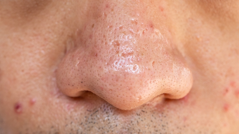 Mụn bọc ở mũi có thể để lại thâm đen, sẹo lõm hoặc tái viêm nhiều lần