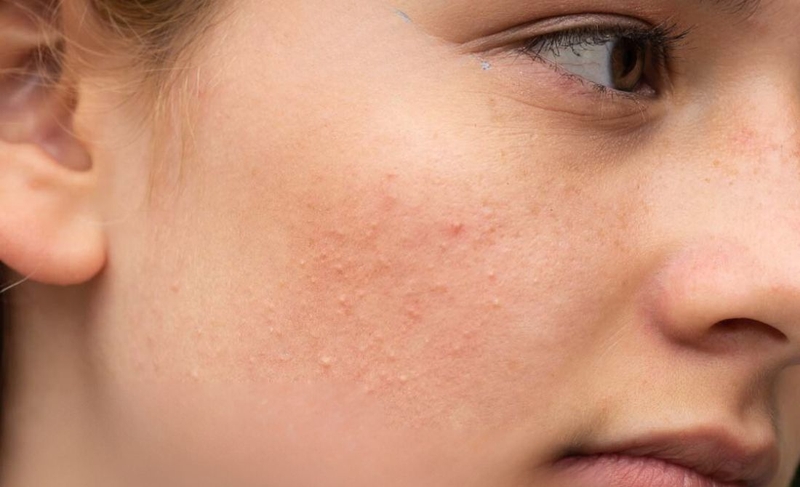 Mụn cám​ có những loại nào? Đặc điểm và cách điều trị 4