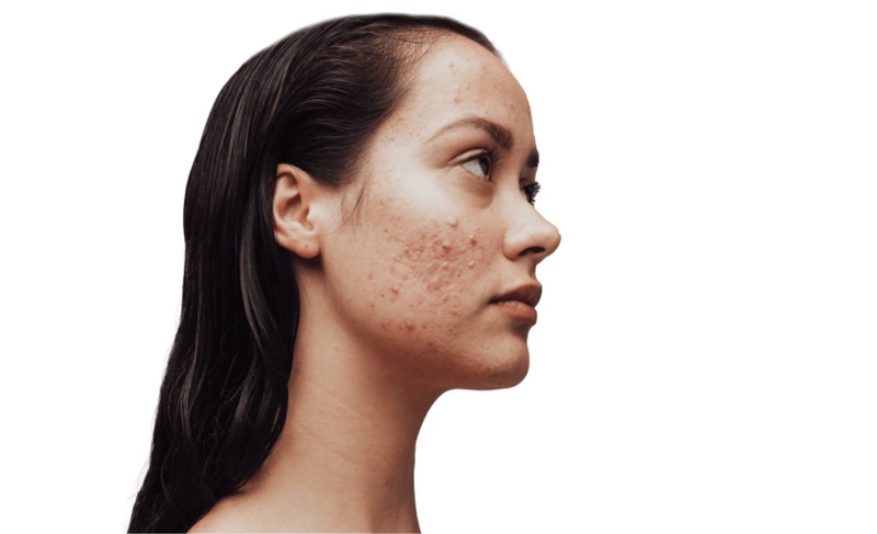 Mụn chai: Nguyên nhân hình thành và cách xử lý 1