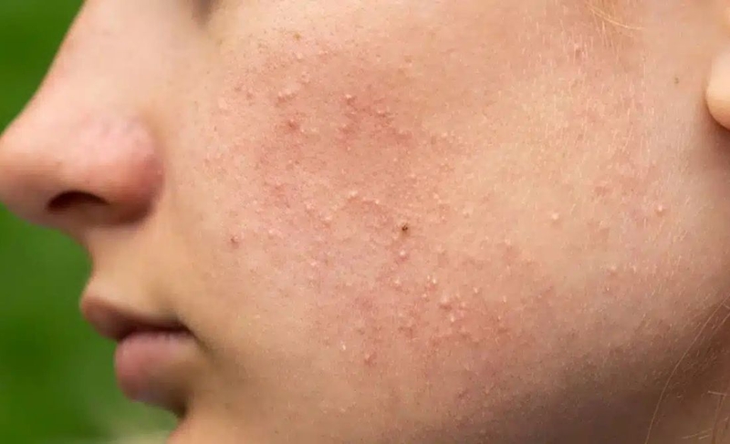 Mụn chai: Nguyên nhân hình thành và cách xử lý 3