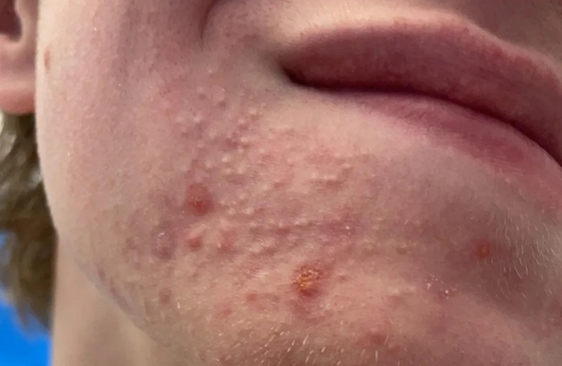 Mụn chai: Nguyên nhân hình thành và cách xử lý 4