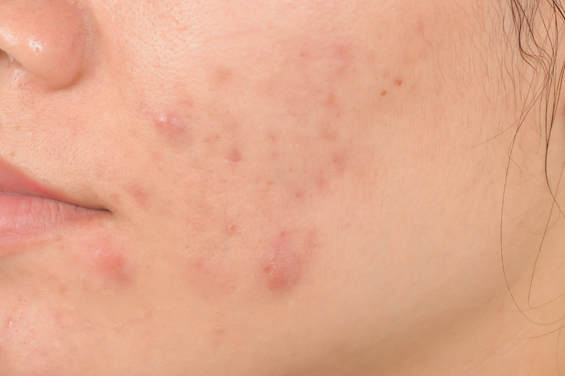 Mụn chai bao lâu thì hết? Bật mí cách điều trị mụn chai hiệu quả 1