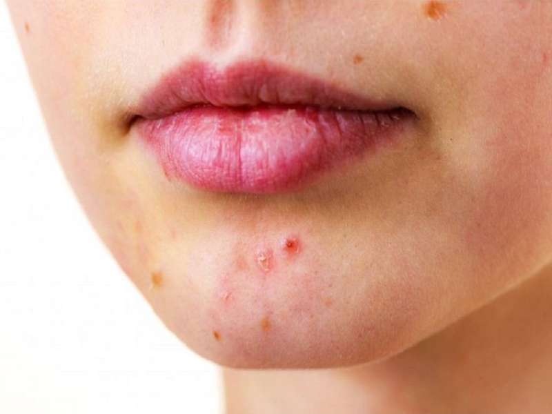 Mụn chai không viêm là gì? Nguyên nhân và cách điều trị 2