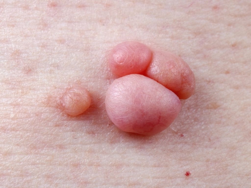 Mụn cóc có đau không? Các biện pháp phòng ngừa mụn cóc hiệu quả 1