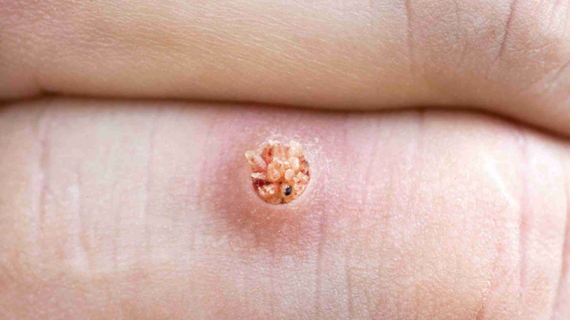 Mụn cóc có ngứa không? Có tự hết không?