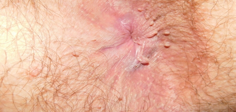 Những điều có thể bạn chưa biết về mụn cóc hậu môn 1