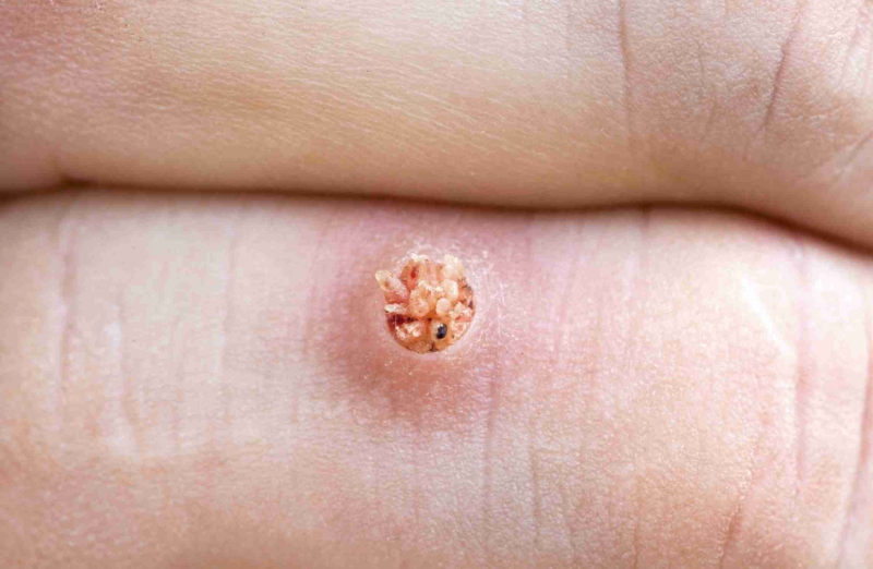 Các loại mụn cóc thường gặp và cách điều trị hiệu quả 1