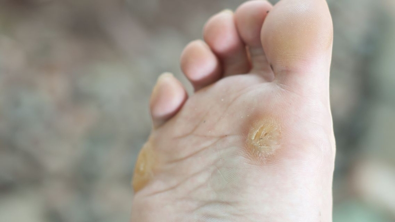 Mụn cóc ở chân: Làm sao để loại bỏ an toàn, không tái phát 1