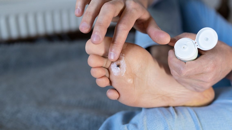 Mụn cóc ở chân: Làm sao để loại bỏ an toàn, không tái phát 3