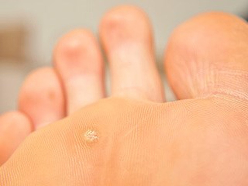 Mụn cóc ở chân có gây nguy hiểm không 1