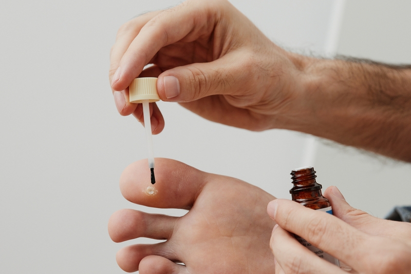 mụn cóc phẳng 2