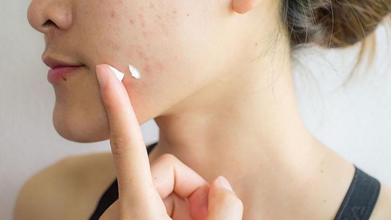 Mụn cóc phẳng: Dấu hiệu nhận biết, nguyên nhân và cách phòng ngừa 6