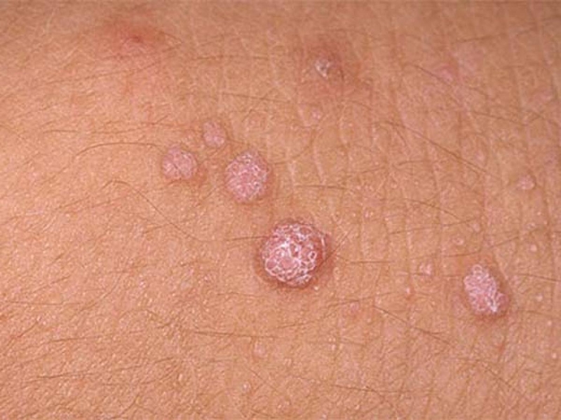 Mụn cóc sinh dục là gì Có ảnh hưởng đến khả năng sinh sản không 1