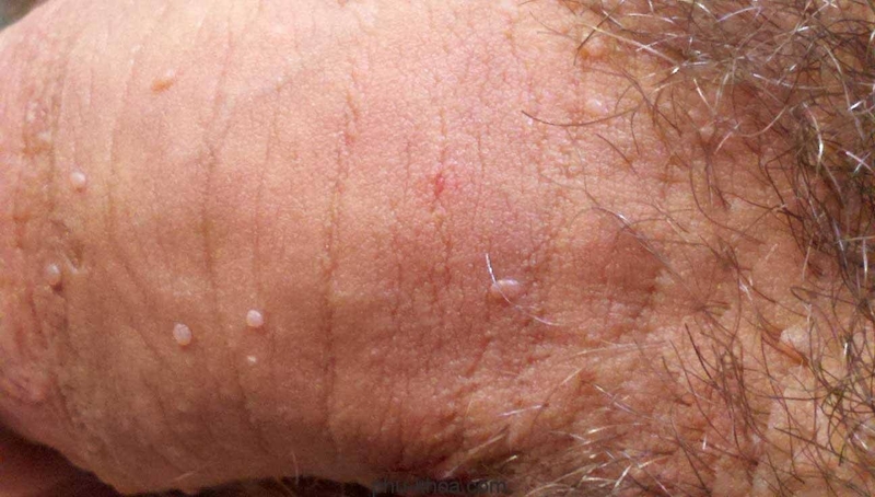 Mụn cóc sinh dục nam và những điều cần lưu ý 1