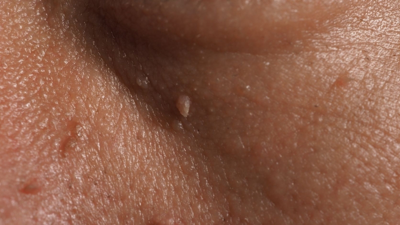 Mụn cóc sinh dục do một số type human papillomavirus (HPV) gây ra