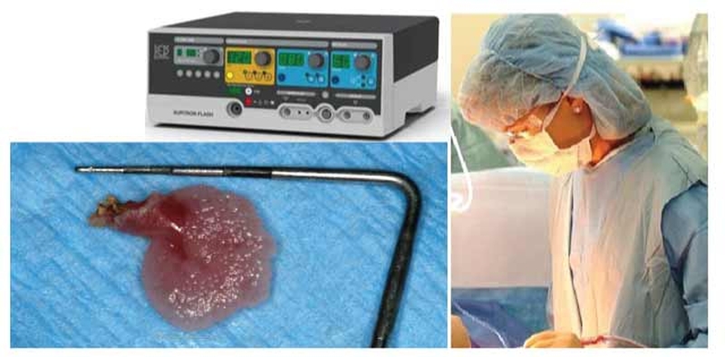 Phân biệt mụn cóc sinh dục và sùi mào gà 5