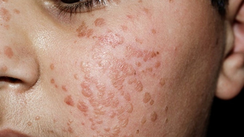 Hình ảnh mụn cóc ở trên mặt