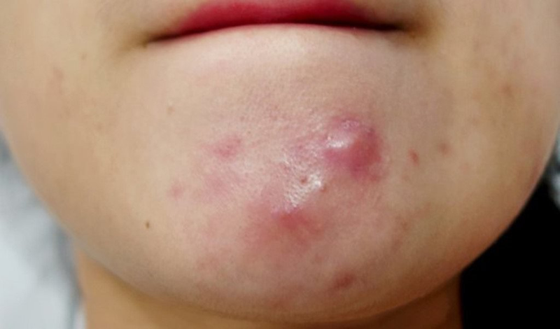 Mụn cứng dưới da: Nguyên nhân và các phương pháp hỗ trợ điều trị 1