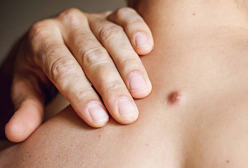 Mụn cứng dưới da: Nguyên nhân và các phương pháp hỗ trợ điều trị 2