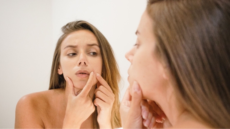 Nặn mụn đầu đen tại nhà có nguy cơ hình thành sẹo
