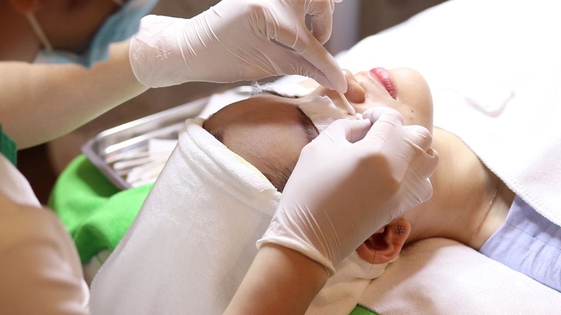 Sau khi nặn mụn đầu đen nên làm gì? 2