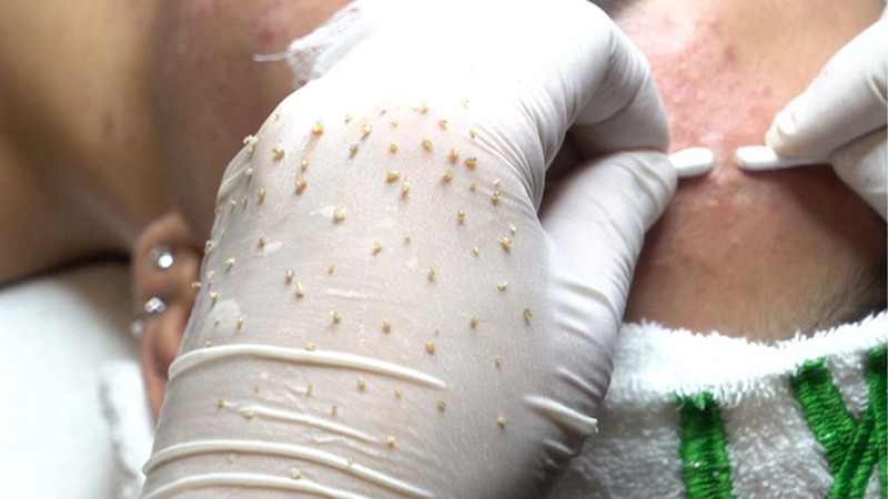 Sau khi nặn mụn đầu đen nên làm gì? 3