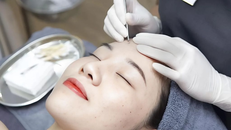 Mụn đầu đen trong lỗ tai: Có nên nặn mụn không? 4