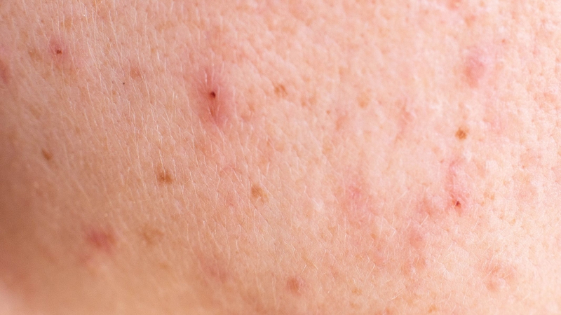 Mụn đầu đinh là gì?