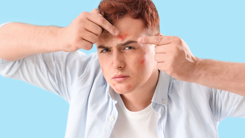 Có nên tự nặn mụn đầu đinh không?