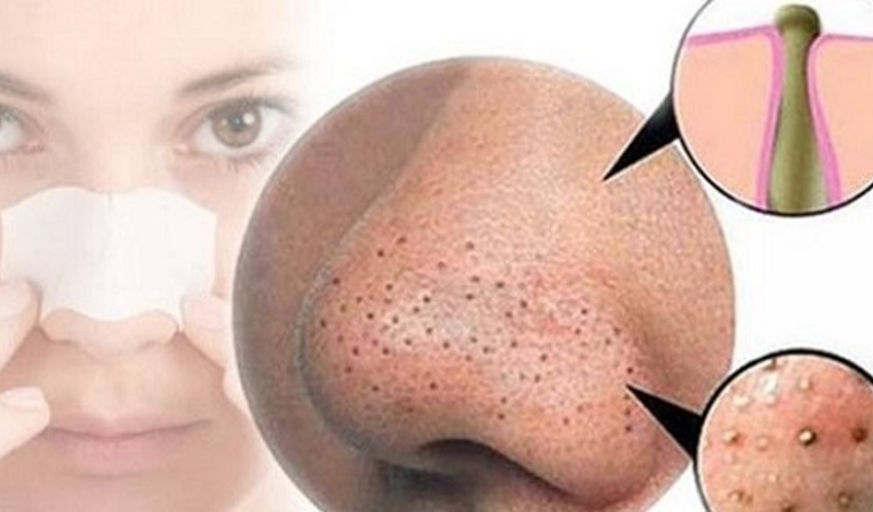 Mụn không nặn có thành nốt ruồi không