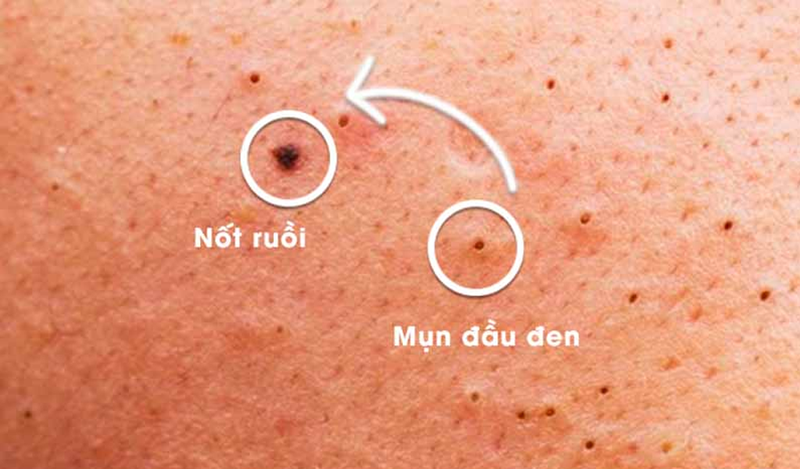 Mụn và nốt ruồi khác nhau ra sao?